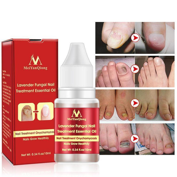New Chinese Cream Nails Finger Toe Protector Fungus Treatment Herb Health Tools Onychomycosis
